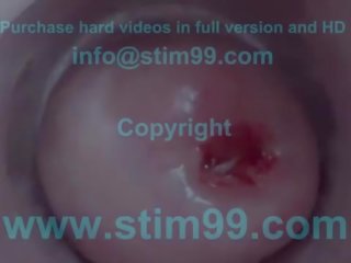 Cervix stretching wide with speculum and sperm insertion in uteru...